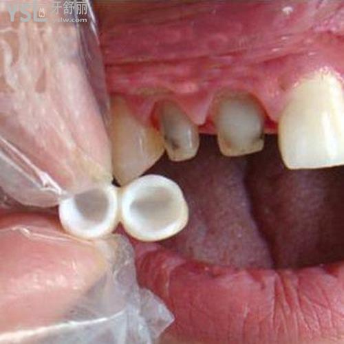 陶瓷牙套和鋼牙套哪個好？
