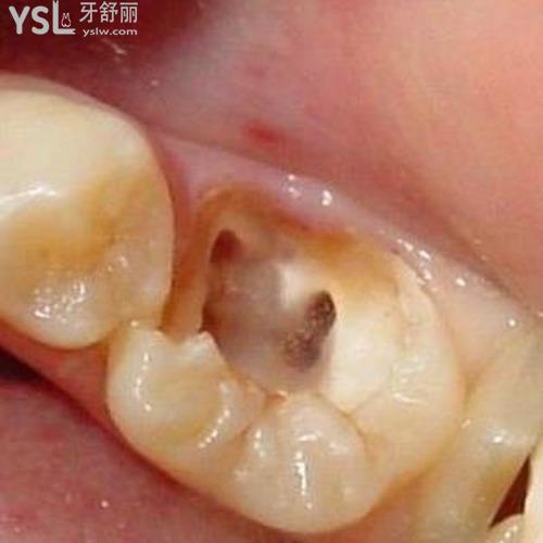 牙齒殺神經(jīng)后怎么還疼？會疼幾天？