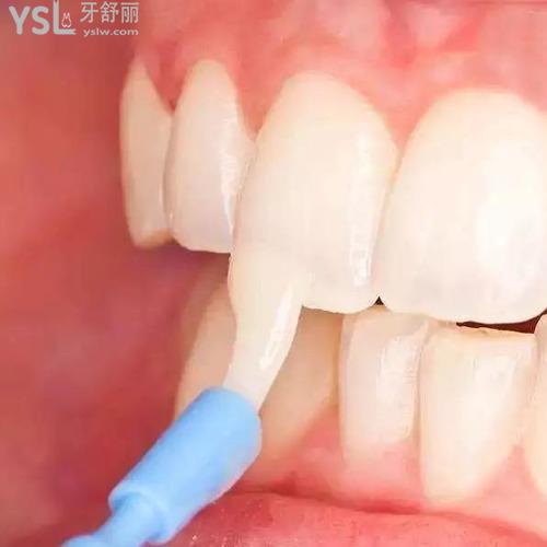 小孩牙齒涂氟有必要嗎？