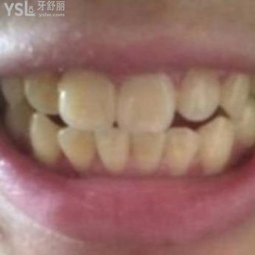 喝茶牙齒會不會黃？
