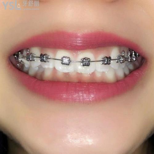 矯正牙齒會(huì)導(dǎo)致牙齦萎縮嗎？