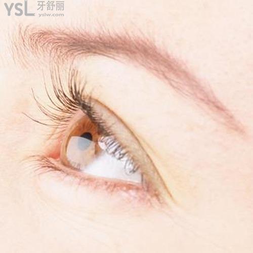 雙眼皮修復(fù)成功率有多少？