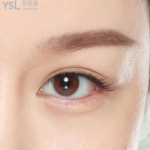 整形割雙眼皮價(jià)格多少？