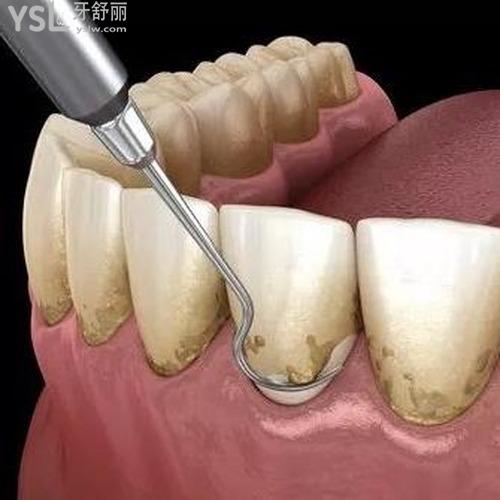 有什么辦法可以牙石脫落？