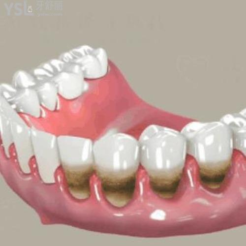 牙齒不堅(jiān)固是怎么回事？