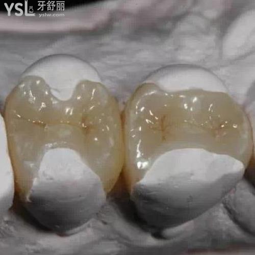 補(bǔ)牙材料哪種好？