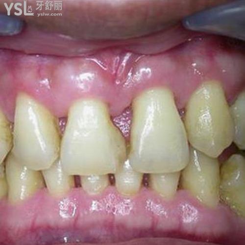 牙根發(fā)黑是什么原因？