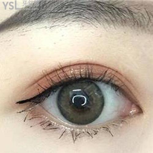 埋線要多久能自然？