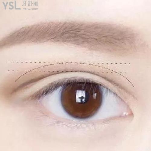 好的雙眼皮該怎么做？