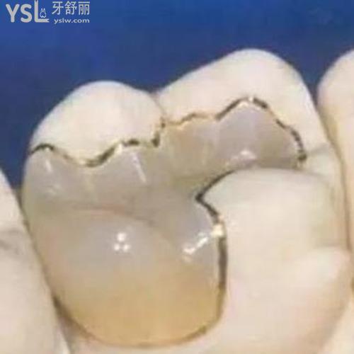 掉了一顆牙補(bǔ)牙怎么補(bǔ)？
