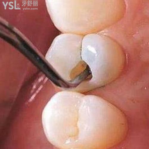 蛀牙就剩牙根了好拔嗎？