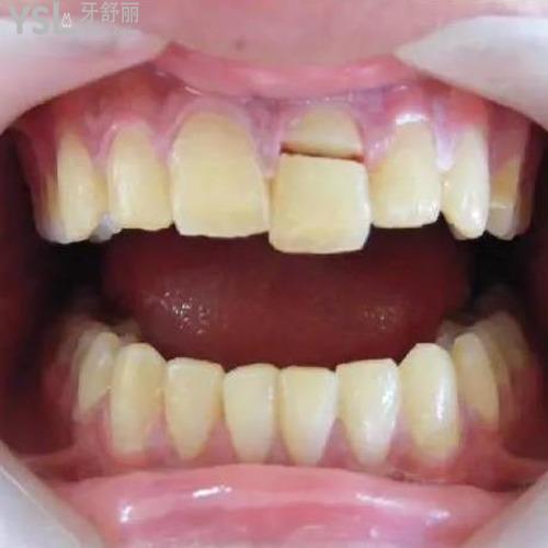 牙齒掉了一塊怎么處理？