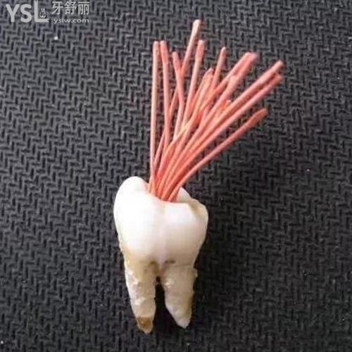 牙疼根管治療是什么意思？
