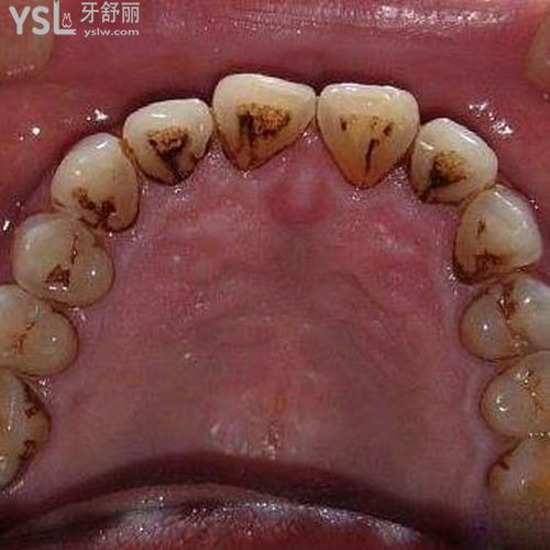 牙齒結(jié)石自己怎么弄掉？