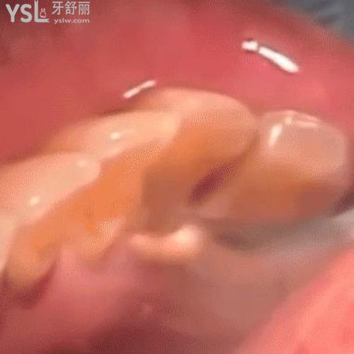 怎么能去除牙結(jié)石？