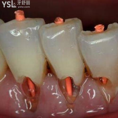 牙漏神經(jīng)了怎么辦？