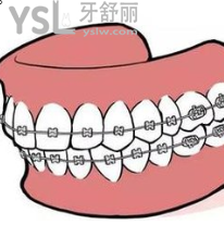 20歲的年輕人做牙套要做什么的？求解答