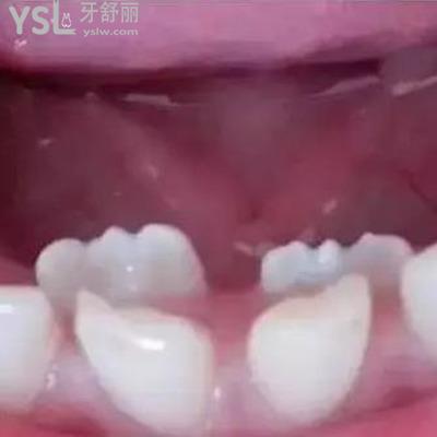 雙排牙齒要拔掉嗎?怎么治療？