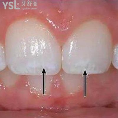 牙齒脫礦怎么治療？