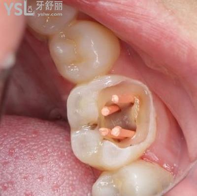 牙齒根管治療是什么意思？