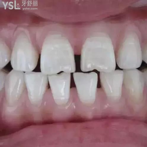 牙齒縫隙變大是什么原因?qū)е拢? class=