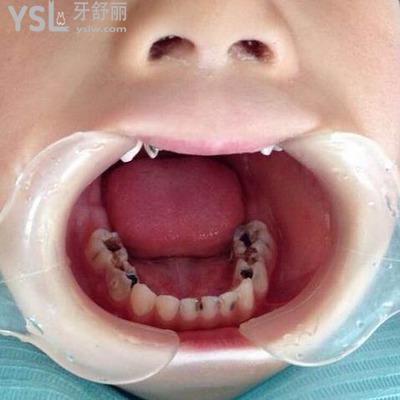 治療兒童蛀牙要多少錢？