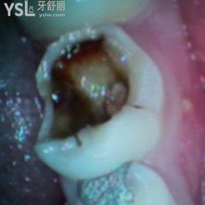 牙齒神經(jīng)壞死了怎么辦？牙神經(jīng)壞死的癥狀是什么？