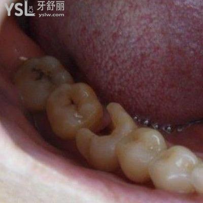 拔牙后根尖炎會消除嗎？根尖炎要怎么治療？