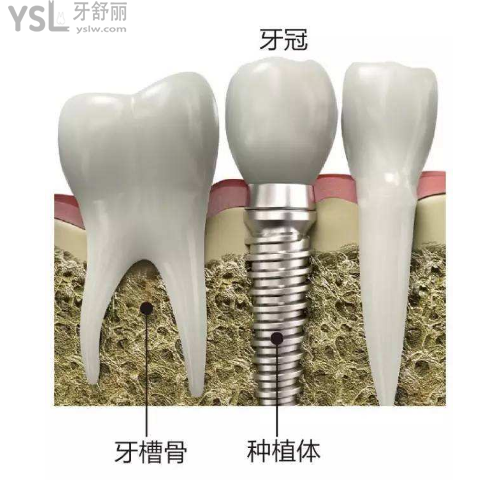 6000與8000種植牙區(qū)別大嗎?選哪個(gè)更好一些[已語(yǔ)音解答]