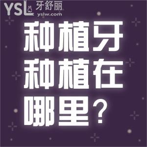 種植牙種植在哪里？種植牙價錢一般要多少？