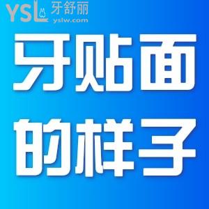 牙貼面是什么樣子？