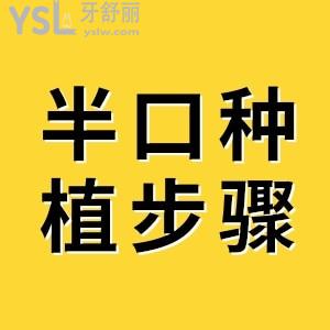 allon4種植牙技術(shù)靠譜嗎 詳細(xì)步驟有什么？