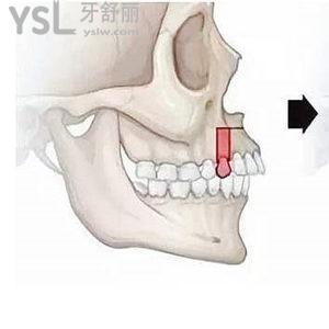 正頜手術前可以不正畸嗎 能直接做手術嗎
