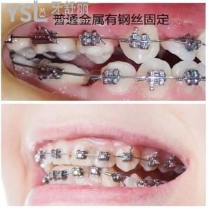 帶牙套期間牙酸是代表牙齒一直在移動嗎？