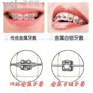 金屬自鎖托槽在牙套中矯正速度是最快的嗎？