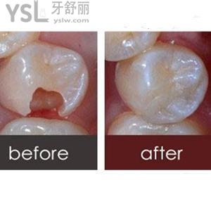 玻璃水門汀是什么材料 補(bǔ)牙好不好？