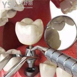 所有的人都可以做種植牙嗎 有沒有不適合的人群？