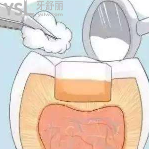 剛補(bǔ)好的牙就掉了一塊怎么辦？