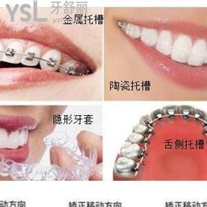 金屬自鎖牙套三萬元貴不貴？