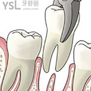 兒童乳牙松動后能不能拔掉？