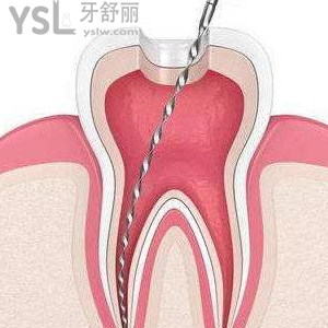 做根管治療要去幾次牙科醫(yī)院？