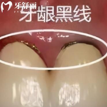 為什么千萬別做烤瓷牙？解析合金牙冠的缺點和挑選方法