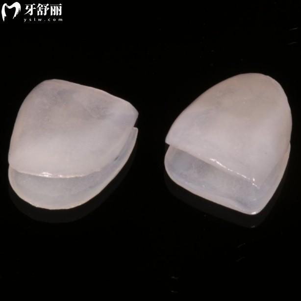 全瓷牙貼面能維持多久？樹脂、烤瓷、陶瓷牙貼面都有什么區(qū)別