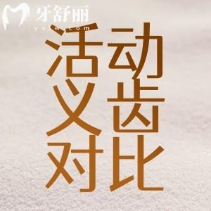 活動義齒哪種最舒服？基托活動假牙/精密附著體/吸附性哪種好？