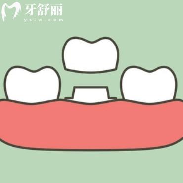 門牙用國產(chǎn)的還是進(jìn)口的全瓷牙好?從各自優(yōu)缺點和價格對比下