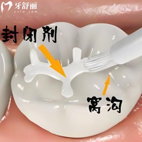家長問窩溝封閉有必要嗎？了解完好處和害處后再做決定