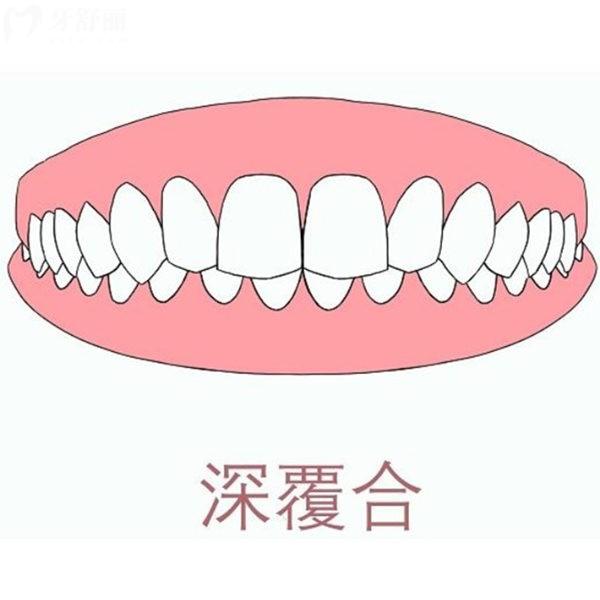 5歲孩子牙齒深覆合要矯正嗎?先了解深覆合對孩子的危害及矯正較佳年齡