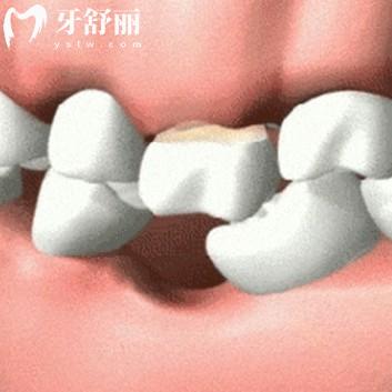 牙齒缺失間隙太小不能種牙怎么辦？缺牙多年真的還可以種牙
