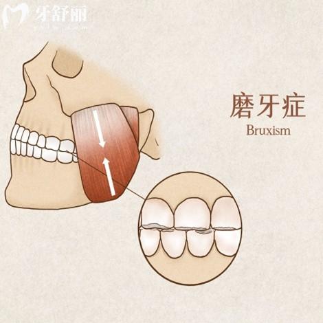 夜間磨牙傷害牙齒嗎?來(lái)分析原因及可以治療的方法