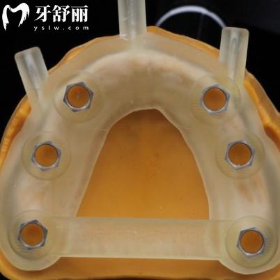 種植牙導(dǎo)板是干什么用的？每顆都要額外收費(fèi)靠譜嗎？